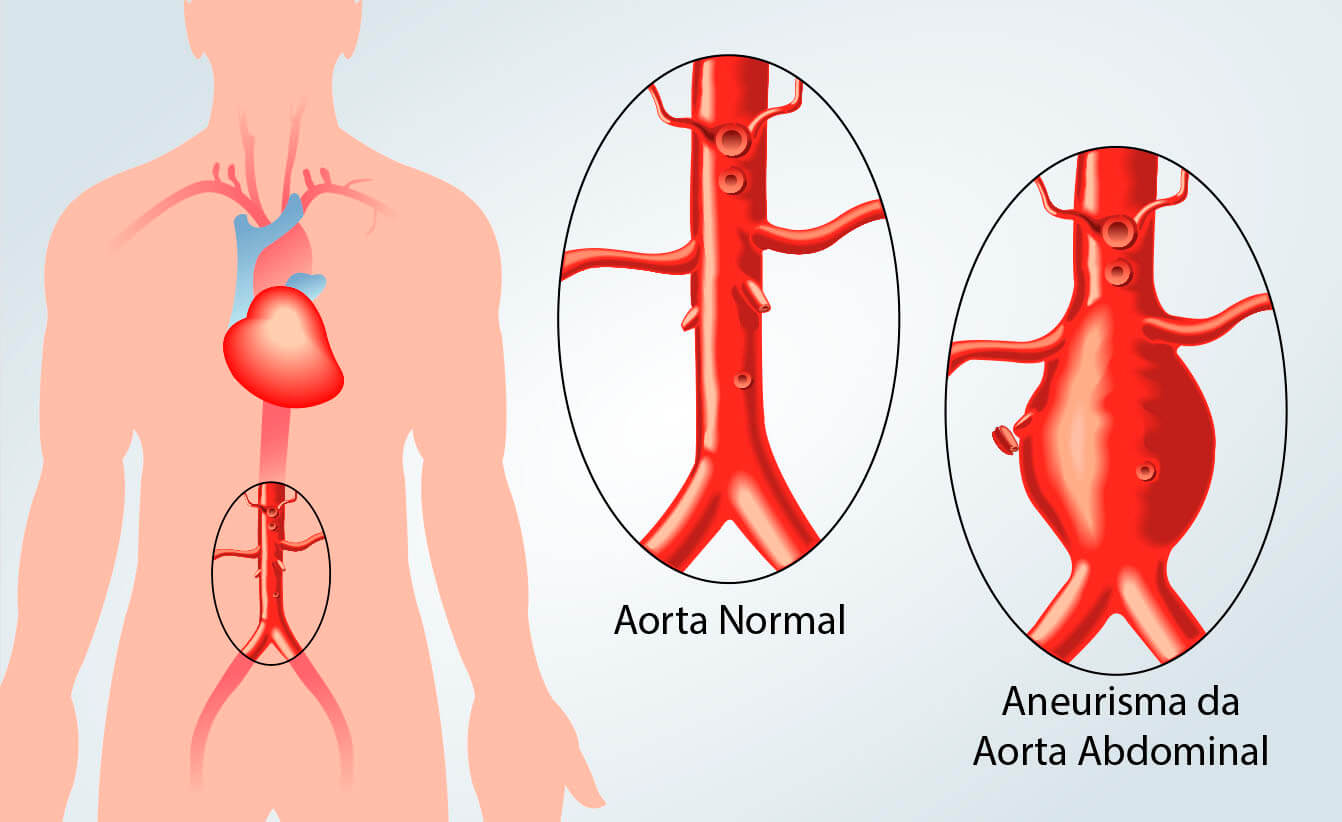 aneurisma da aorta abdominal2
