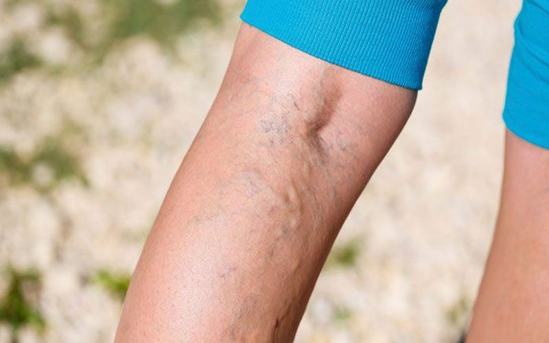 cause-of-varicose-veins-in-youth