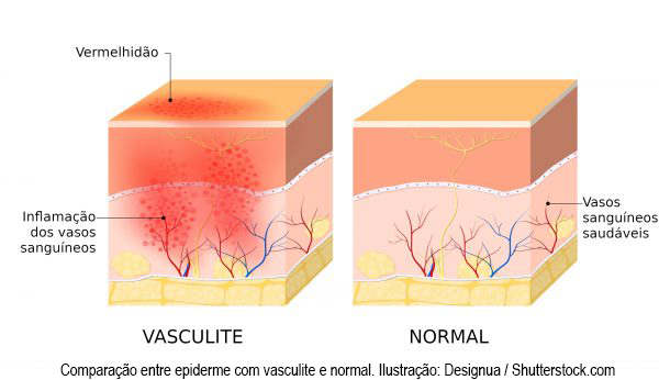 vasculite-1195928671-600x346