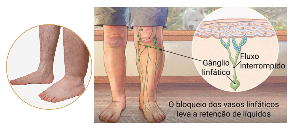 linfedema